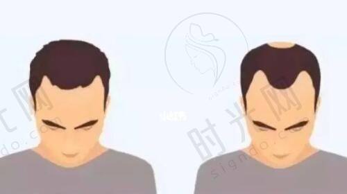 哈尔滨医 大四院美容科双眼皮手术成效揭秘