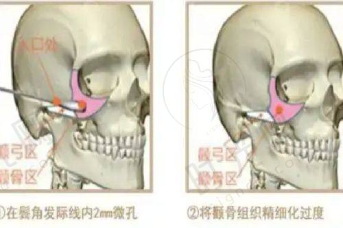 眼部筋膜提升术后注意事项