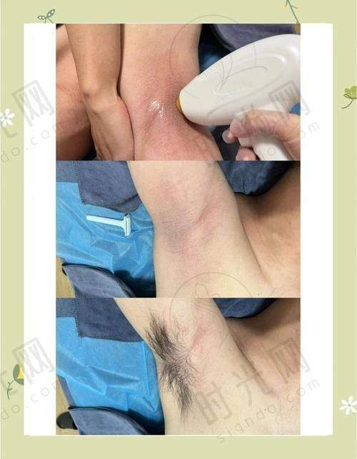 5、太原美莱整形医院——太原私立三等甲激光脱毛高端之选