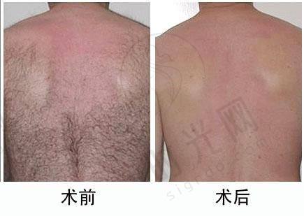 8、山西铝厂职工医院——太原老牌医院激光脱毛经典之选
