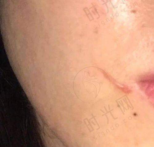上海治疗疤痕疙瘩的骨干医生