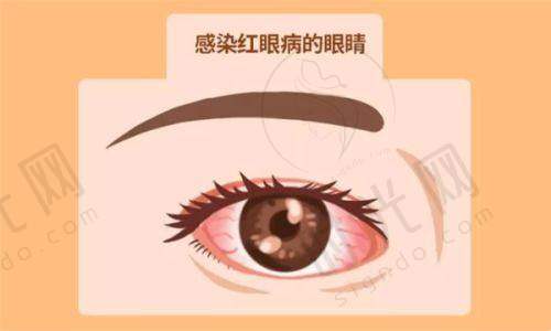 普瑞眼科收费贵吗