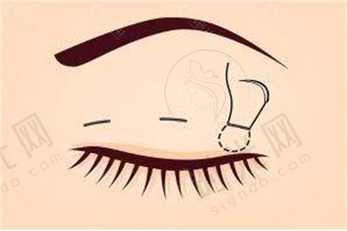 五、直腿术术后护理要点