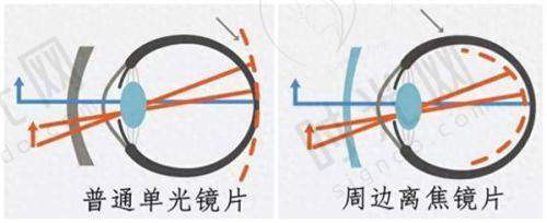 三、手术适用人群精细匹配指南