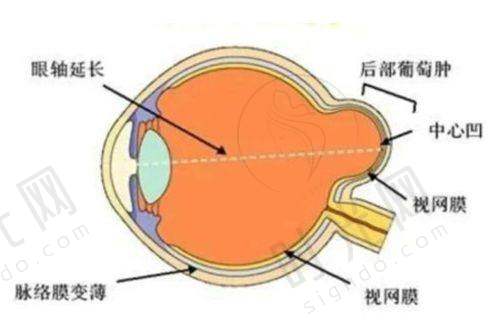 青光眼手术