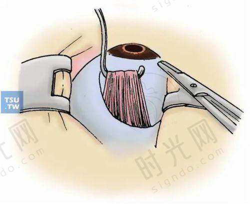 镜片