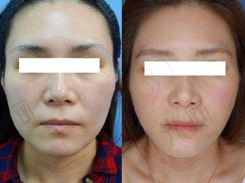 北京加减美黄寅守V美减龄拉皮50000元起，专做拉皮维持十年显年轻