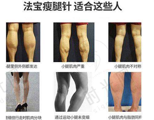 广州韩妃做风筝小拉皮手术提升下颌缘成效佳的原因