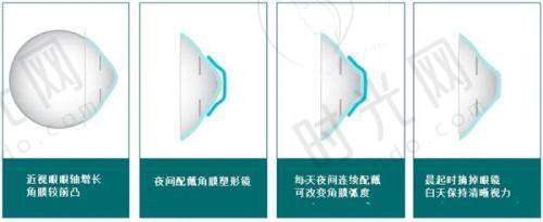 爱尔眼科全光塑手术价格解析
