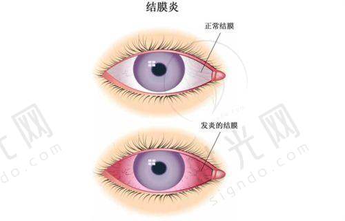 哈尔滨医 大二院眼科做近视眼手术的技术优势