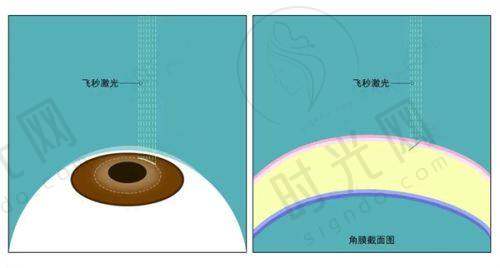 农村老人免费做白内障手术申请条件与材料