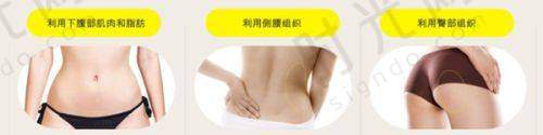 钻石超塑下颌缘 vs 传统溶脂：为什么它维持更久？