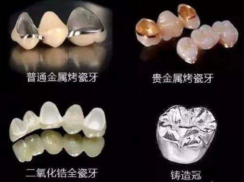 ? 美国3M拉瓦全瓷牙能保多少年？医生技术是“隐形保质期”：差1毫米精度，少5年寿命