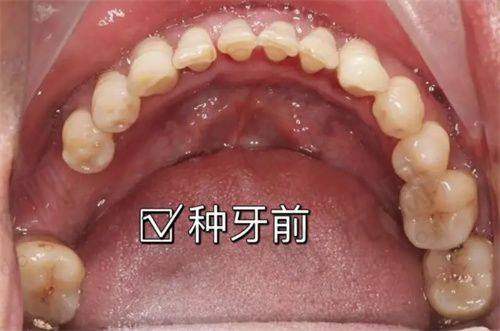 结尾：牙齿松了别慌，先做这2件事！