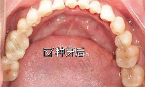 二、关键治疗步骤：从检查到固定，分几步走？