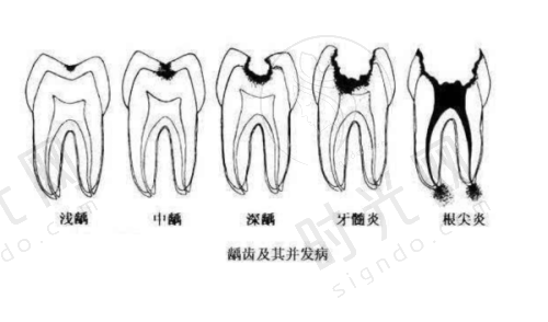 3.1 引发口腔疾病的“重灾区”