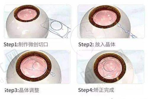 飞秒激光近视手术要多少钱？全飞秒vs半飞秒，哪类更适合你的预算与需求？