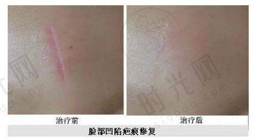 25-35岁抗衰女性打薇旖美合适吗