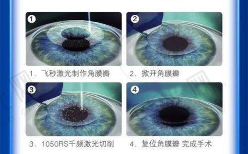 全飞秒多少钱全新手术价格：2025年“省钱攻略”，3招立省5000元，学生党/上班族必看！