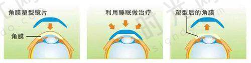 后巩膜加固手术常见问题解答