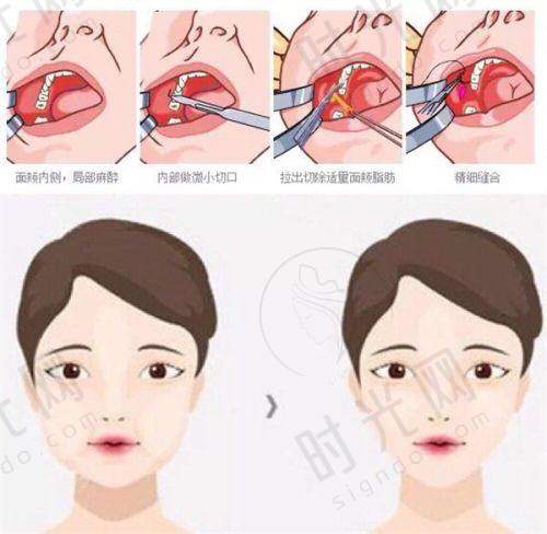 薇旖美胶原蛋白打哪里更划算？