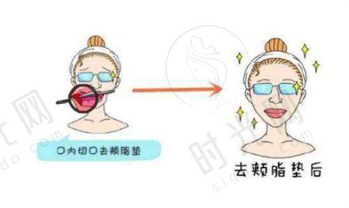 SRT100疤痕放疗有副作用吗？术后护理要做好