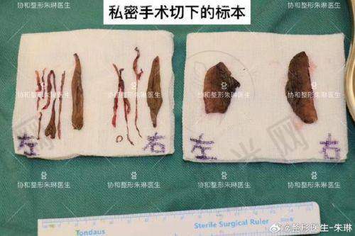 阴痉弯曲矫正手术后多久能修复性生活？医生这样说