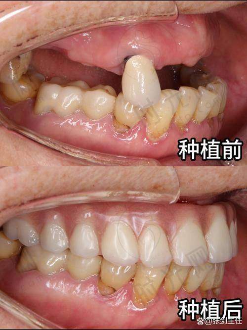 避坑 + 实操：3招让松动牙“重新长紧”，医生手把手教你做