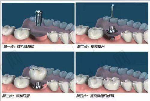 四、避坑+实操：选修复方案别踩这3个雷！附2025护理指南