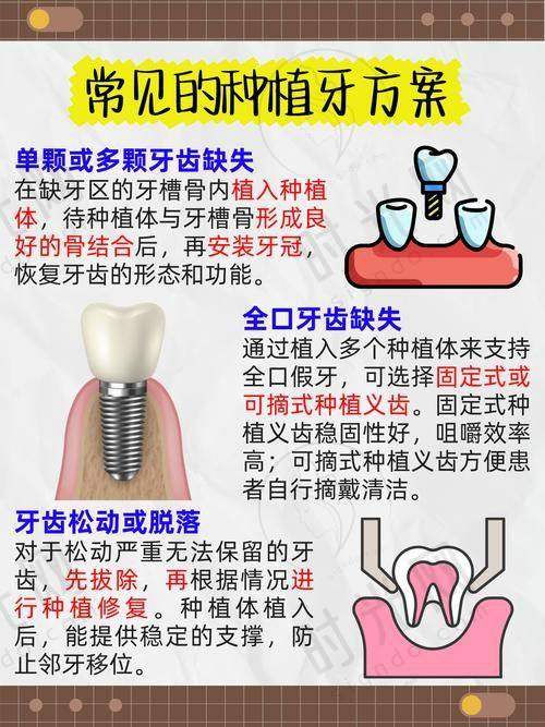 总结:种植牙不需要满口种植,选对方案省钱又省心