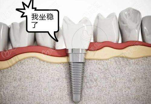 三、种植牙怎么选不花冤枉钱?内行人都看这3点