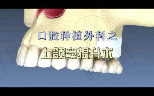 二、一般的种植牙费用受哪些因素影响?别花冤枉钱!
