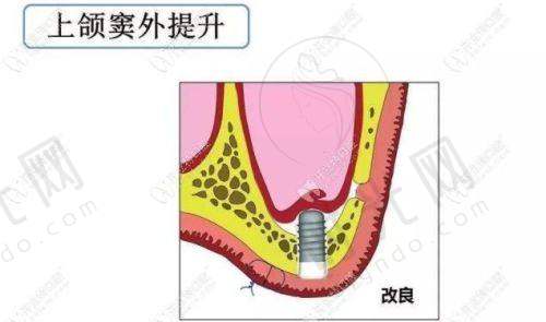 六、种植牙术后怎么护理?这样做能用20年以上!