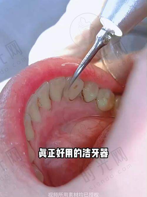 四、避坑！这些“牙齿固定”方法别踩雷