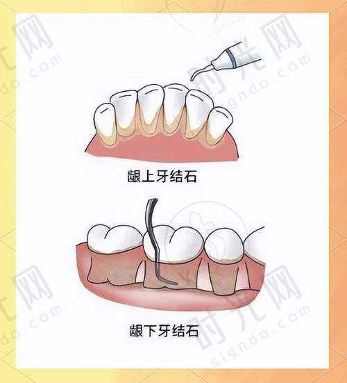 三、五十岁牙齿松动是缺钙吗？补钙+护牙，2件事要“做对”