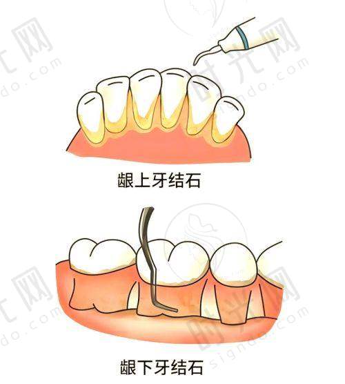 总结：松牙固定有几种方法？选对方法，松牙也能“用到老”