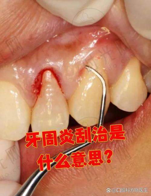 三、不同原因导致的牙龈松动，修复方法大不同！别用错方法白花钱