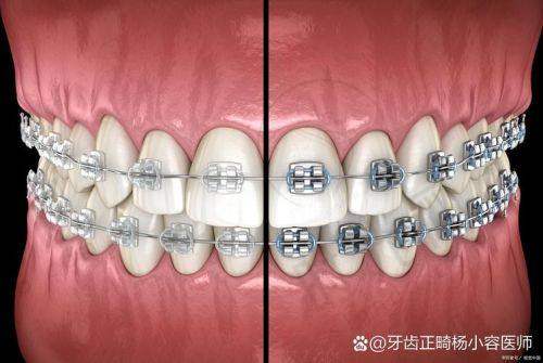 二、大门牙松动了怎么办？先分清3大原因，对症补救还能救