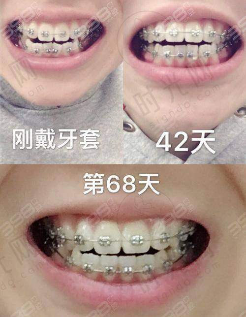 四、总结：牙齿松动能修复吗？关键在