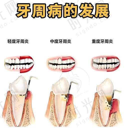 6. 牙龈清洁不到位：“每天刷牙还不够”，这些死角藏着“松动隐患”