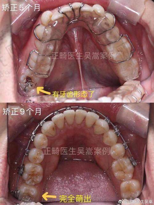 4. 龋齿（蛀牙）：从“小黑点”到“松动牙”，细菌在悄悄“蛀空牙根”