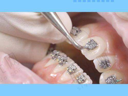 5. 整牙是隐形的好还是钢牙好?拼“自律”:谁更考验“自觉性”?