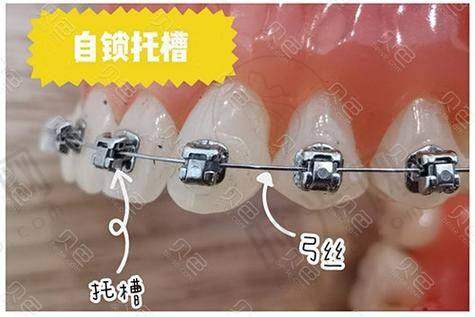1. 坑点:隐形牙套的“附加费用”比你想的多