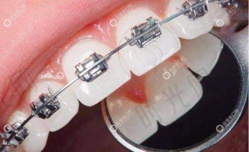 3. 整牙是隐形的好还是钢牙好?中老年人:选隐形,兼顾“面子”和“口腔健康”