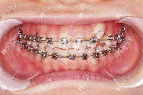 3. 整牙是隐形的好还是钢牙好?关键看“钱包”:价格差了近3倍!