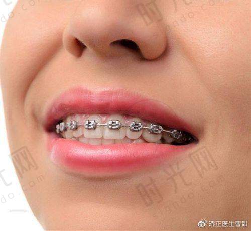 3. 第三步:测“自律性”,能坚持戴22小时选隐形,否则选钢牙