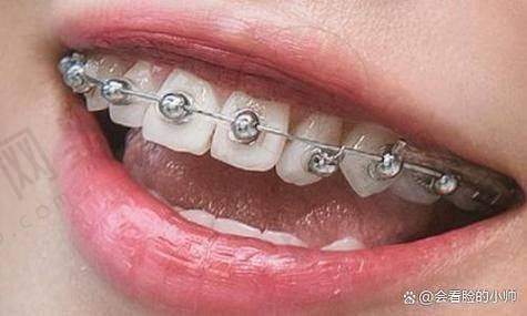 4. 整牙是隐形的好还是钢牙好?牙齿复杂病例:听医生的,钢牙可能更稳妥