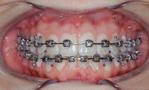 2. 整牙是隐形的好还是钢牙好?再看“舒服”:佩戴体验谁更友好