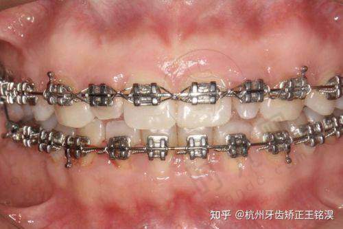 二、为什么要纠结隐形还是钢牙?先搞懂你的“整牙需求”