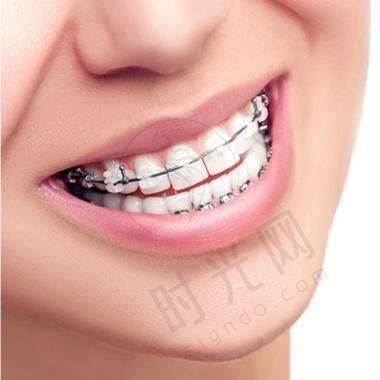 1. 第一步:先看“牙齿难度”,简单选隐形,复杂选钢牙